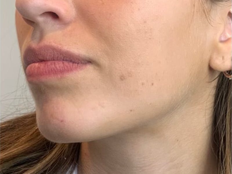 Jaw Filler Before & After Gallery - Patient 87552000 - Image 5