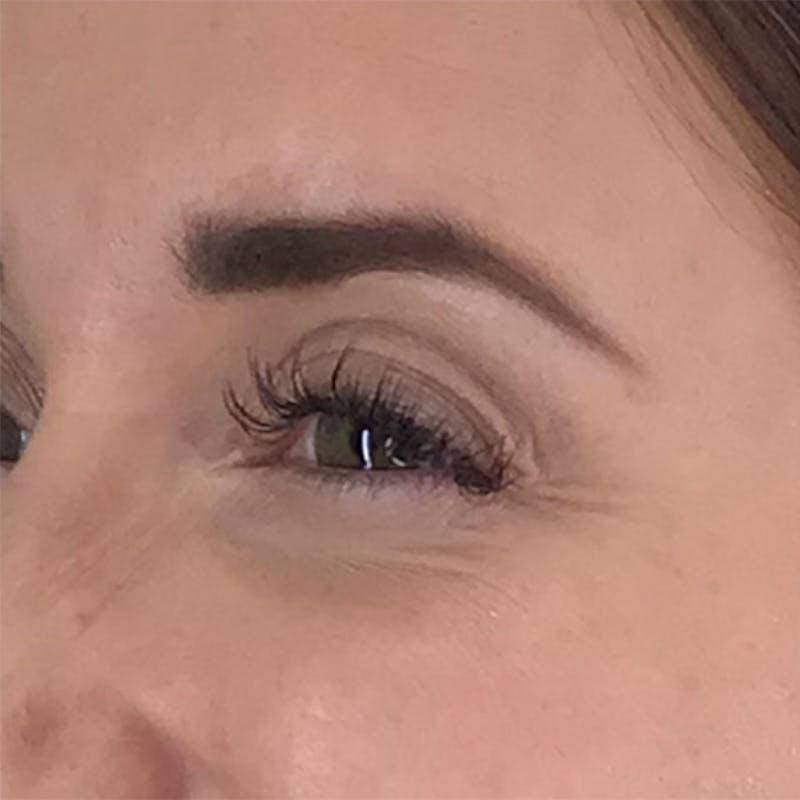 BOTOX Before & After Gallery - Patient 87552002 - Image 3