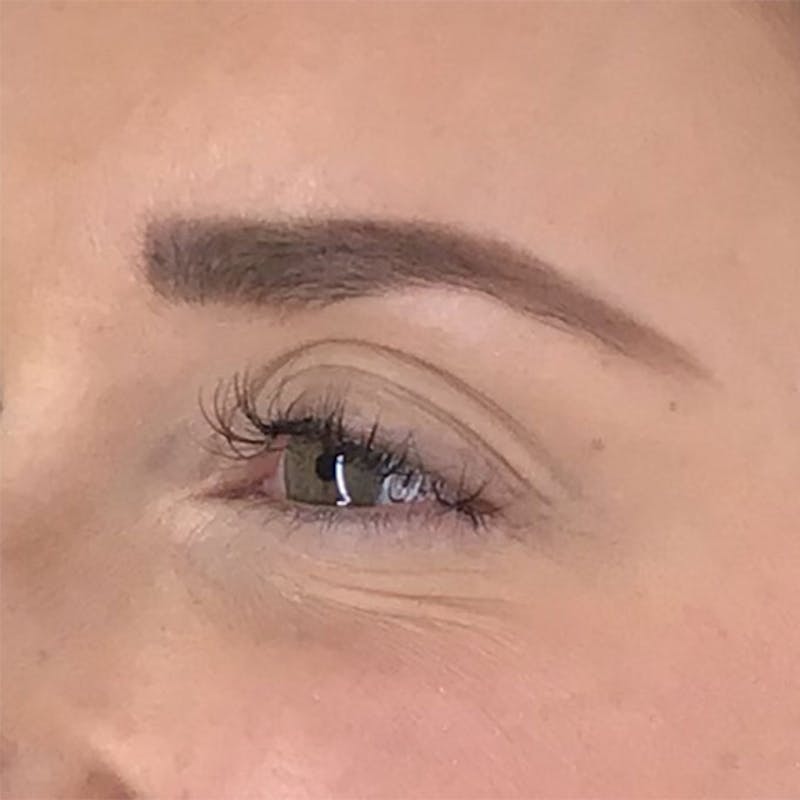 BOTOX Before & After Gallery - Patient 87552002 - Image 4