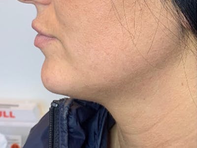 Jaw Filler Before & After Gallery - Patient 87552005 - Image 1