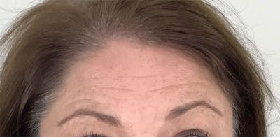 BOTOX Before & After Gallery - Patient 87552018 - Image 1
