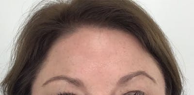 BOTOX Before & After Gallery - Patient 87552018 - Image 2