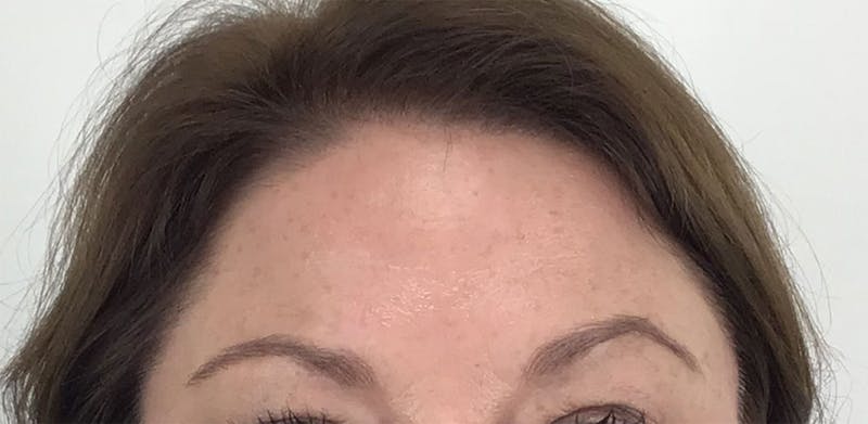 BOTOX Before & After Gallery - Patient 87552018 - Image 2