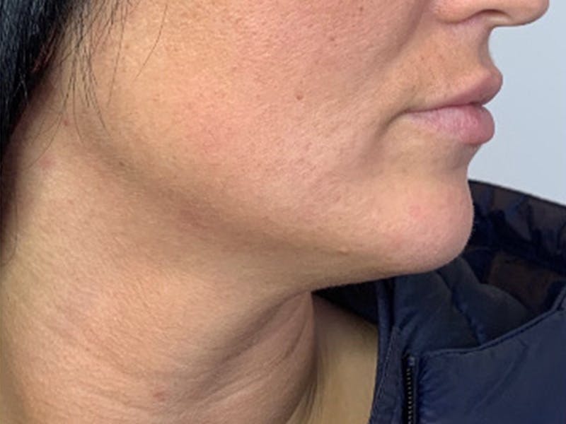 Jaw Filler Before & After Gallery - Patient 87552005 - Image 3
