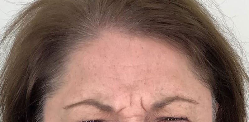 BOTOX Before & After Gallery - Patient 87552018 - Image 3