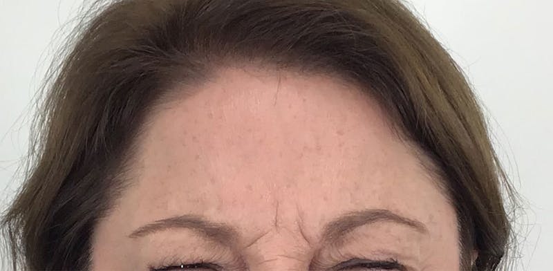 BOTOX Before & After Gallery - Patient 87552018 - Image 4