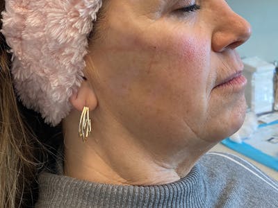 Jaw Filler Before & After Gallery - Patient 87552019 - Image 1