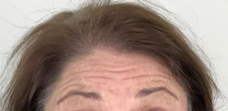 BOTOX Before & After Gallery - Patient 87552018 - Image 5