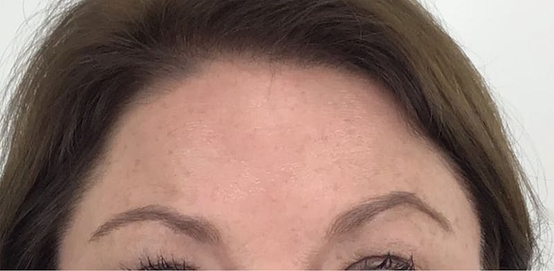 BOTOX Before & After Gallery - Patient 87552018 - Image 6