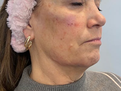Jaw Filler Before & After Gallery - Patient 87552019 - Image 2