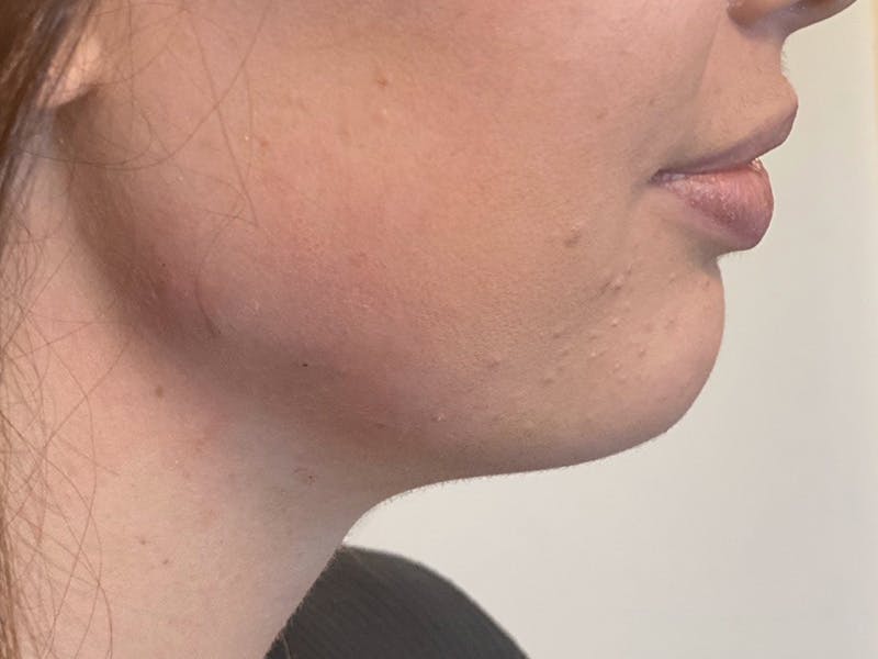 Jaw Filler Before & After Gallery - Patient 87552022 - Image 2