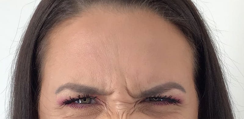 BOTOX Before & After Gallery - Patient 87552033 - Image 3