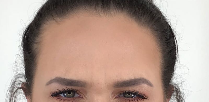 BOTOX Before & After Gallery - Patient 87552033 - Image 4