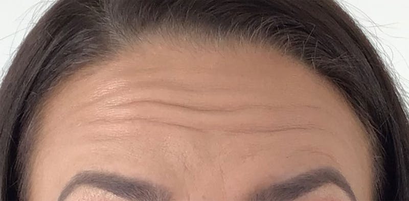 BOTOX Before & After Gallery - Patient 87552033 - Image 5