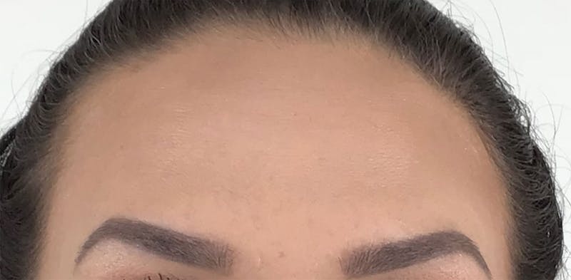 BOTOX Before & After Gallery - Patient 87552033 - Image 6