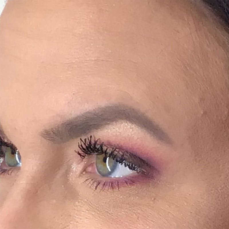 BOTOX Before & After Gallery - Patient 87552033 - Image 7