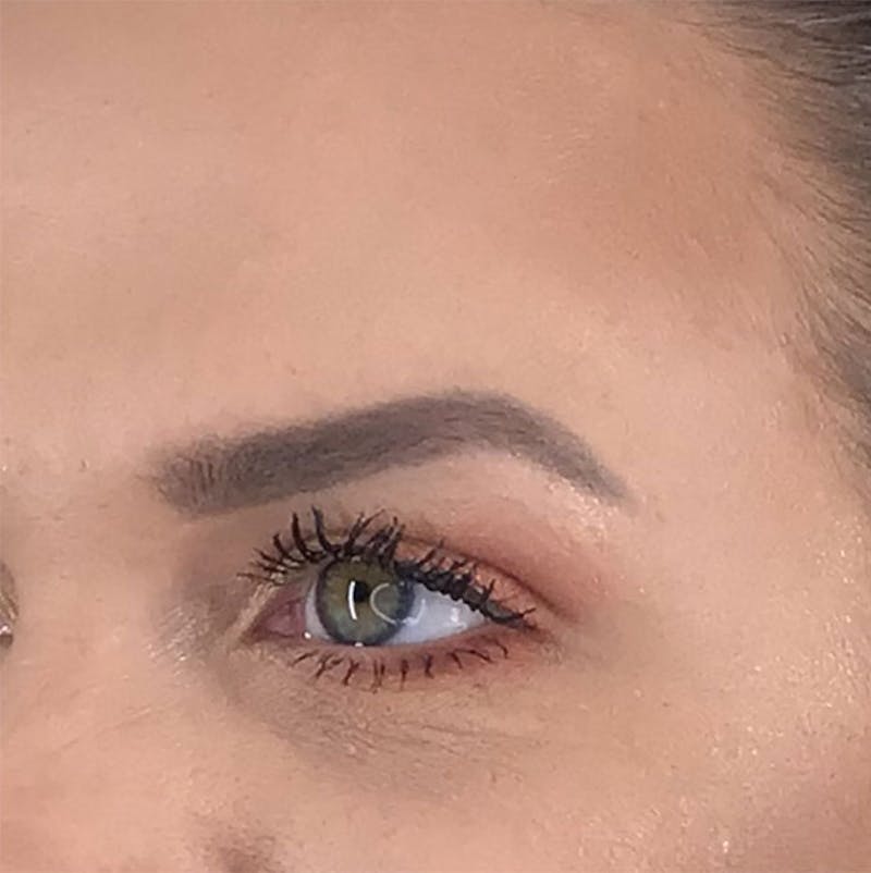 BOTOX Before & After Gallery - Patient 87552033 - Image 8