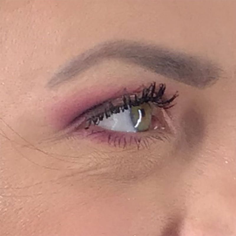 BOTOX Before & After Gallery - Patient 87552033 - Image 9