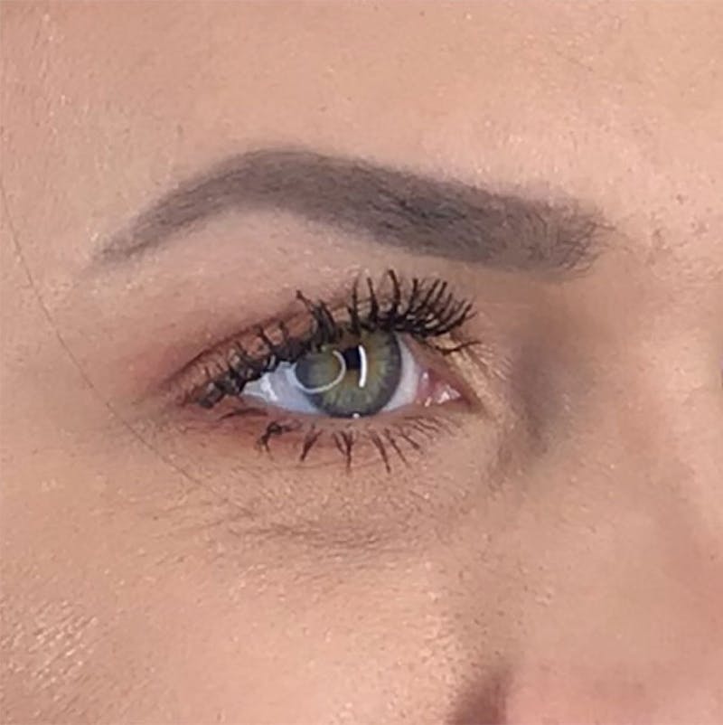 BOTOX Before & After Gallery - Patient 87552033 - Image 10