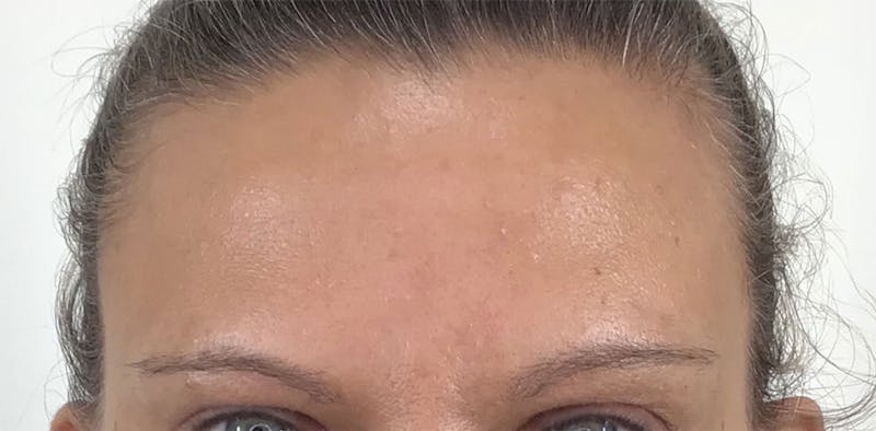BOTOX Before & After Gallery - Patient 87552081 - Image 2