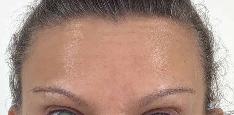 BOTOX Before & After Gallery - Patient 87552081 - Image 4
