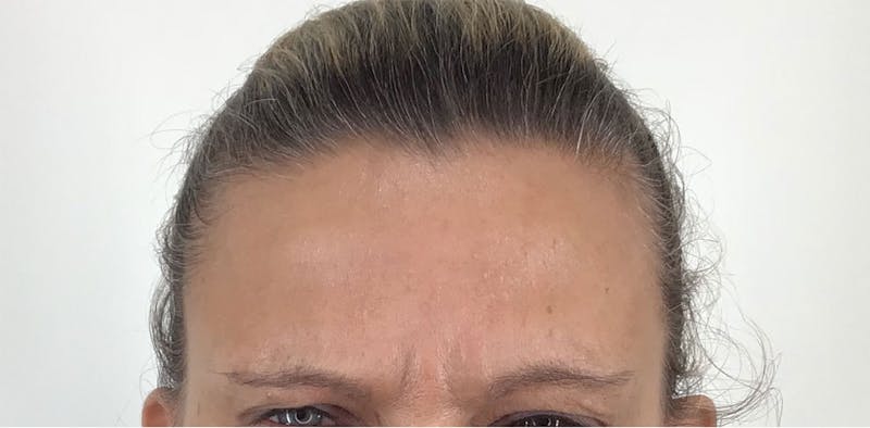 BOTOX Before & After Gallery - Patient 87552081 - Image 6