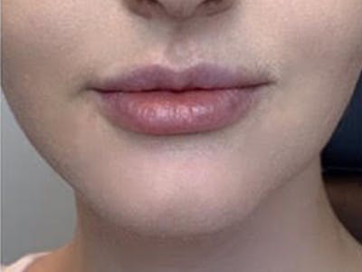 Lip Filler Before & After Gallery - Patient 87552057 - Image 1