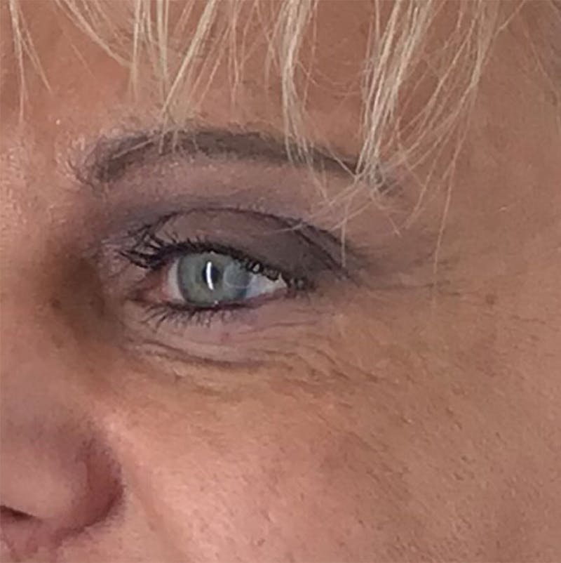 BOTOX Before & After Gallery - Patient 87552081 - Image 7