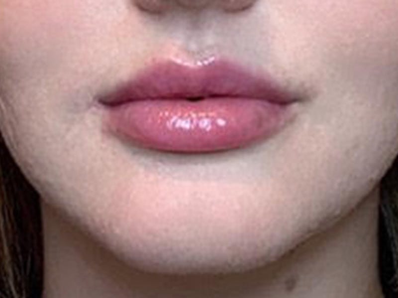 Lip Filler Before & After Gallery - Patient 87552057 - Image 2