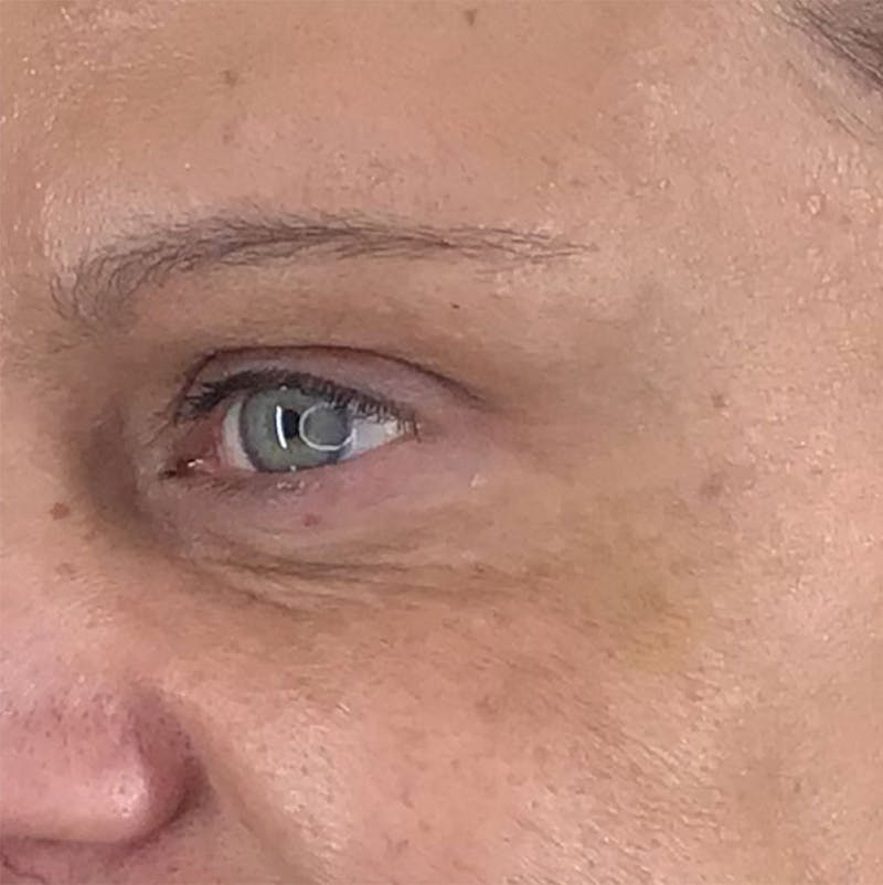 BOTOX Before & After Gallery - Patient 87552081 - Image 8