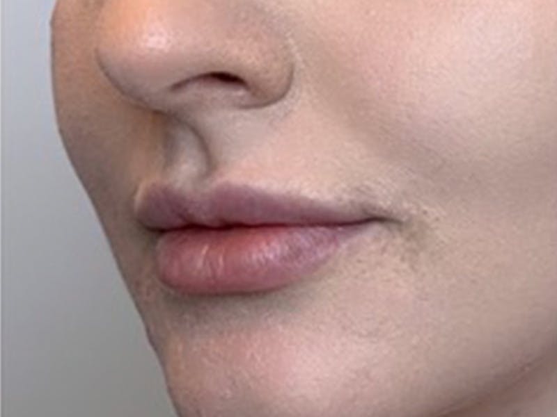 Lip Filler Before & After Gallery - Patient 87552057 - Image 3