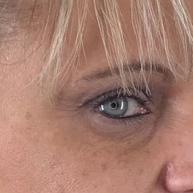 BOTOX Before & After Gallery - Patient 87552081 - Image 9