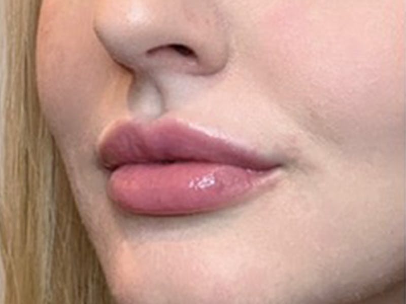 Lip Filler Before & After Gallery - Patient 87552057 - Image 4