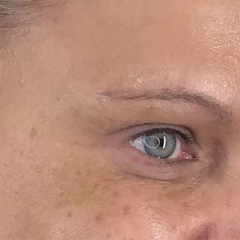 BOTOX Before & After Gallery - Patient 87552081 - Image 10