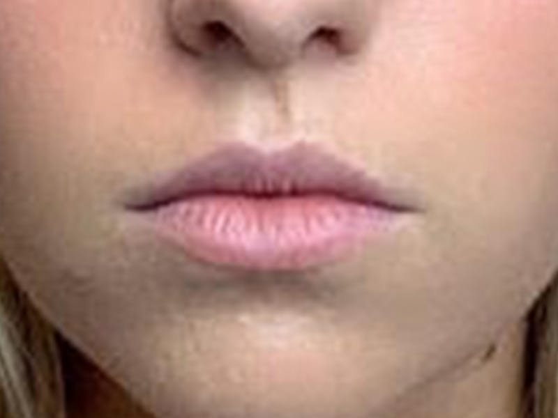 Lip Filler Before & After Gallery - Patient 87552085 - Image 1