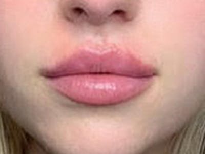 Lip Filler Before & After Gallery - Patient 87552085 - Image 2