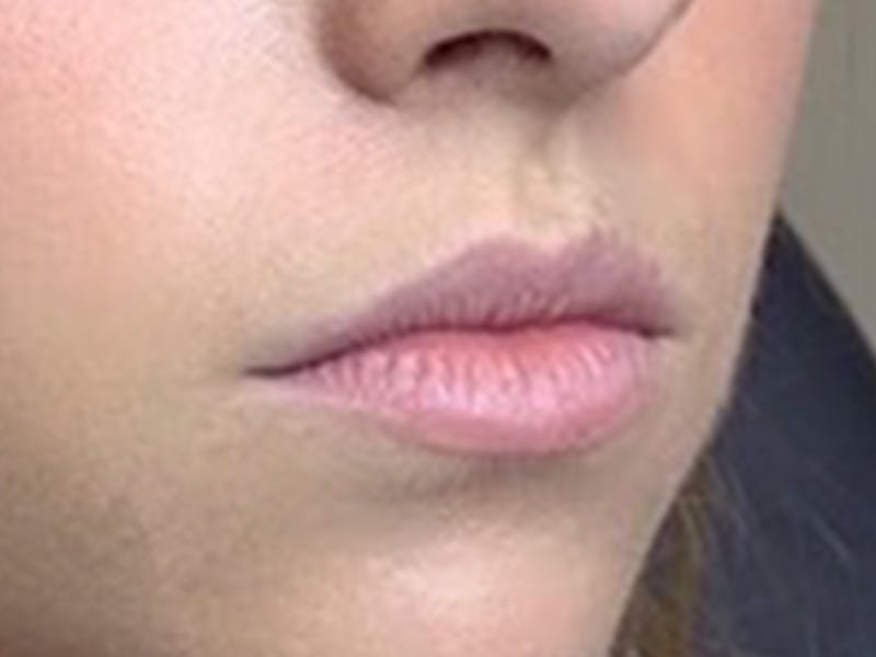 Lip Filler Before & After Gallery - Patient 87552085 - Image 3