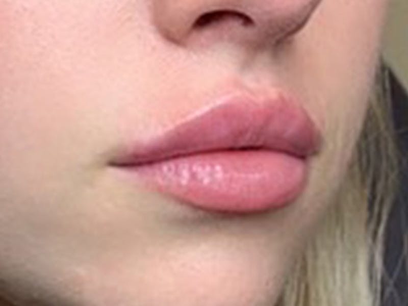 Lip Filler Before & After Gallery - Patient 87552085 - Image 4