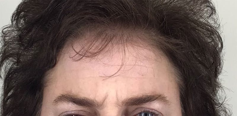 BOTOX Before & After Gallery - Patient 87552087 - Image 3