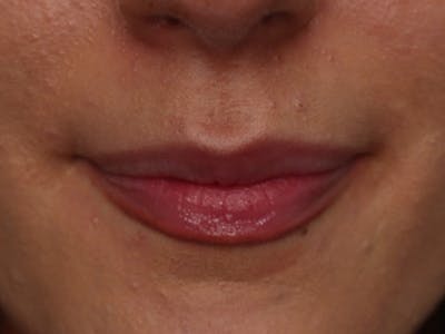 Lip Filler Before & After Gallery - Patient 87552090 - Image 1