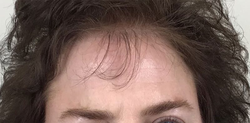 BOTOX Before & After Gallery - Patient 87552087 - Image 4