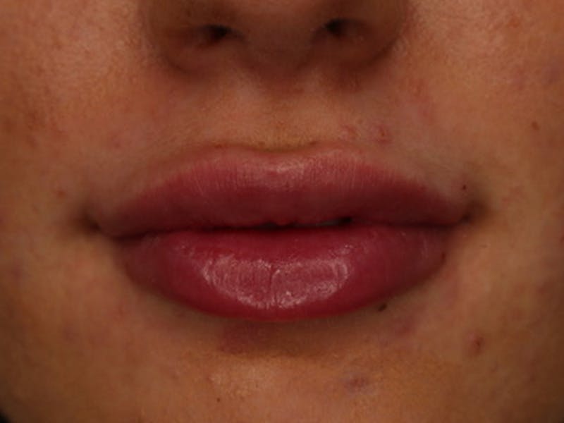 Lip Filler Before & After Gallery - Patient 87552090 - Image 2