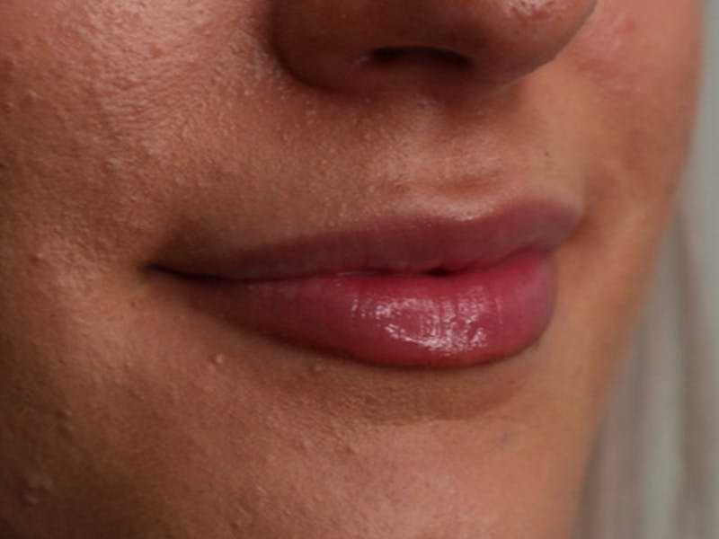 Lip Filler Before & After Gallery - Patient 87552090 - Image 3