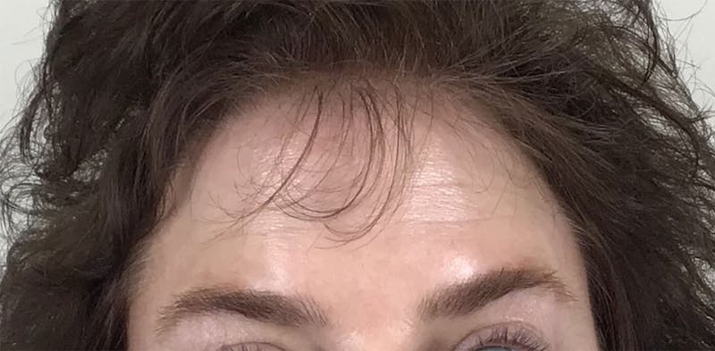 BOTOX Before & After Gallery - Patient 87552087 - Image 6