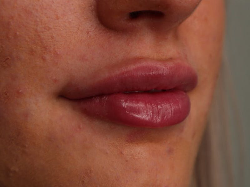 Lip Filler Before & After Gallery - Patient 87552090 - Image 4