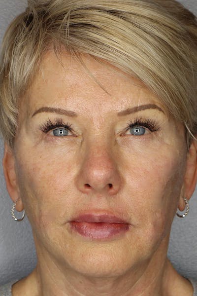 Liquid Lift Before & After Gallery - Patient 87552088 - Image 2