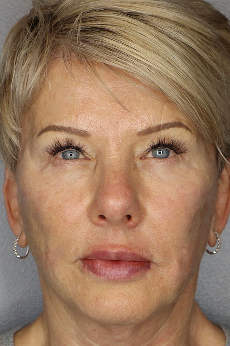 Liquid Lift Before & After Gallery - Patient 87552088 - Image 2