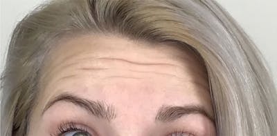 BOTOX Before & After Gallery - Patient 87552106 - Image 1