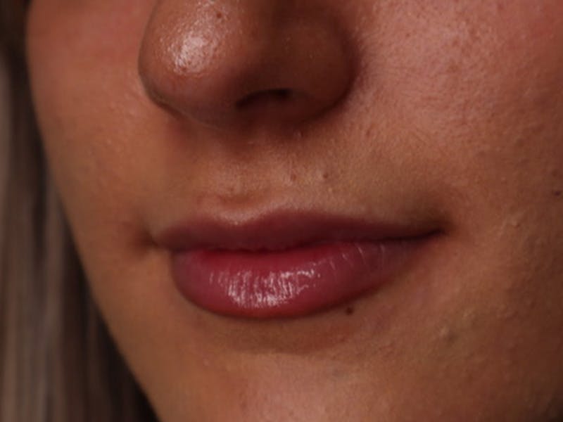 Lip Filler Before & After Gallery - Patient 87552090 - Image 5