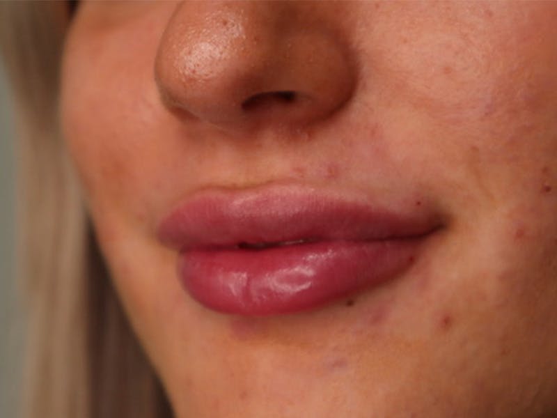 Lip Filler Before & After Gallery - Patient 87552090 - Image 6